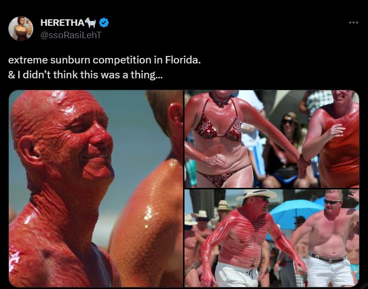 Extreme sunburn competition